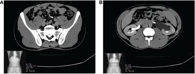 Case report: Primary Ewing sarcoma of the ureter, an exceptional finding of unique manifestation of disease